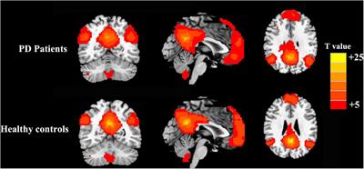 Altered Default Mode Network Functional Connectivity in Parkinson’s Disease: A Resting-State Functional Magnetic Resonance Imaging Study